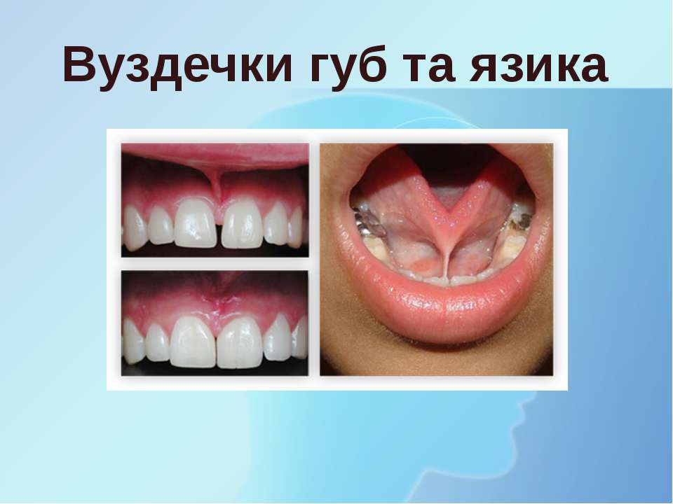 Вуздечки губ та язика - Скачать презентации бесплатно ☑ Презентации по предметам на gdz-books.ru