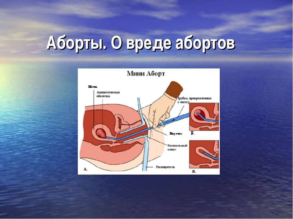Аборты. О вреде абортов - Скачать презентации бесплатно ☑ Презентации по предметам на gdz-books.ru