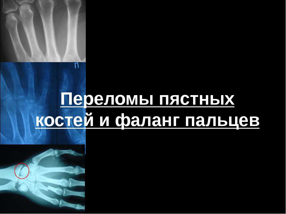 Переломы пястных костей и фаланг пальцев  - Скачать презентации бесплатно | Читать или скачать учебники для школы онлайн бесплатно ☑ Школьные учебники school-textbook.com