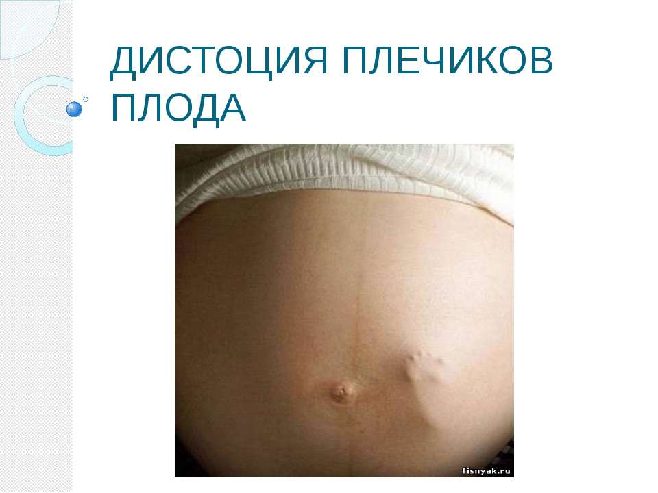 Дистоция плечиков плода - Скачать презентации бесплатно ☑ Презентации по предметам на gdz-books.ru
