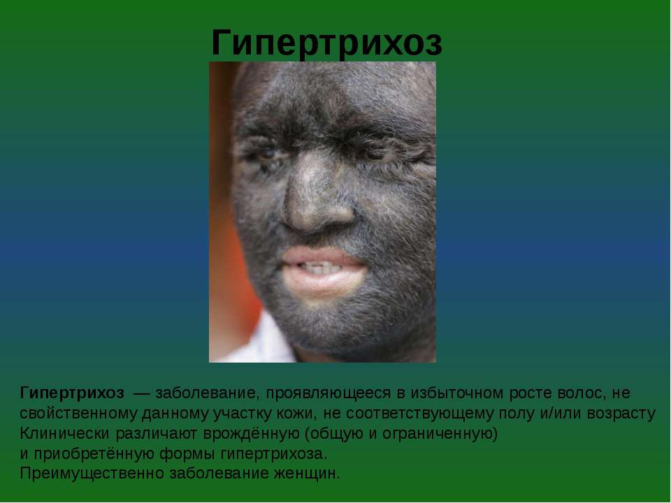 Гипертрихоз  - Скачать презентации бесплатно ☑ Презентации по предметам на gdz-books.ru