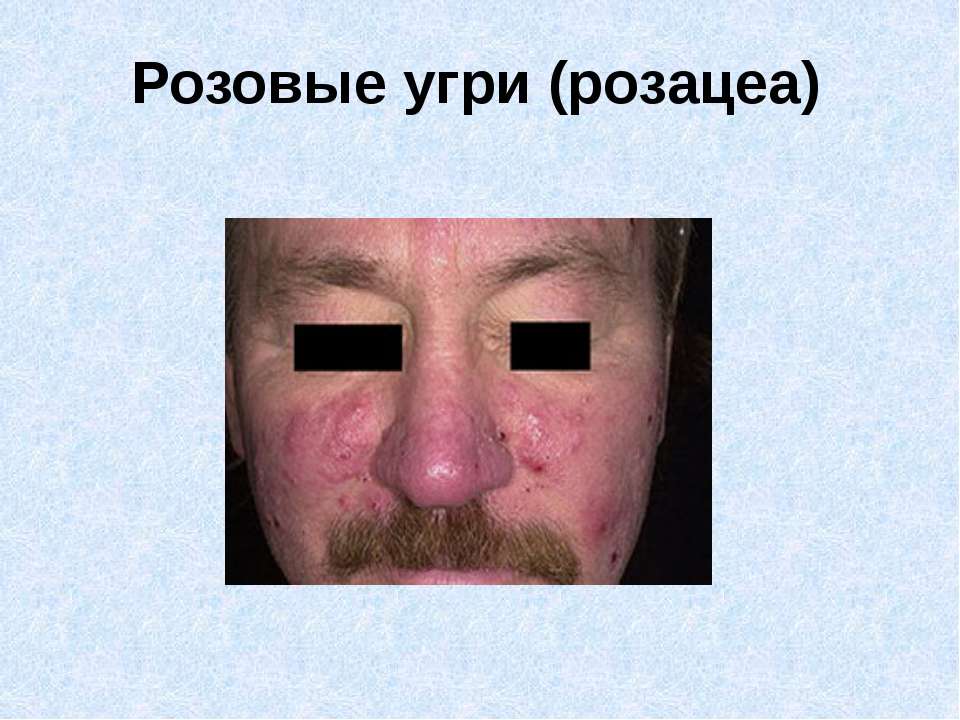 Розовые угри (розацеа) - Скачать презентации бесплатно | Читать или скачать учебники для школы онлайн бесплатно ☑ Школьные учебники school-textbook.com